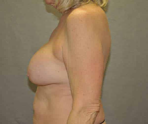 Breast Lift