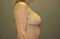 Breast Reduction
