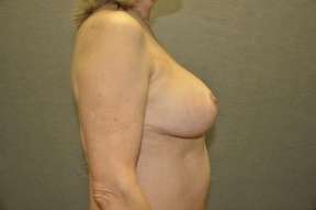 Breast Reduction