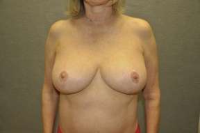 Breast Reduction