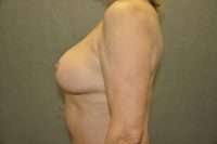 Breast Reduction