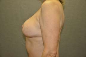 Breast Reduction