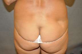 Fat Transfer Breast Augmentation Result Scottsdale