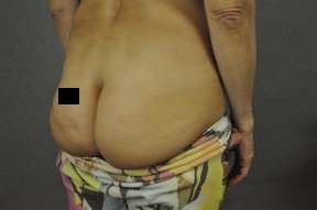 Fat Transfer