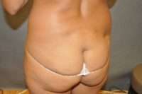 Fat Transfer