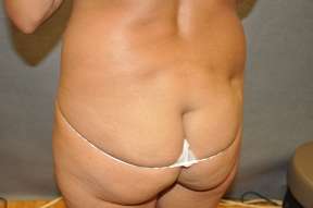 Fat Transfer
