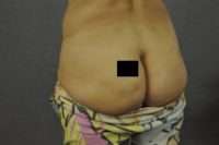 Fat Transfer