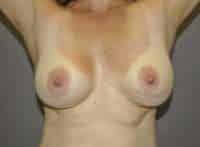 Breast Lift