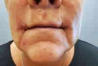 Corner Lip Lift