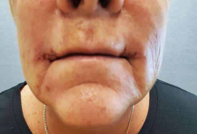 Corner Lip Lift