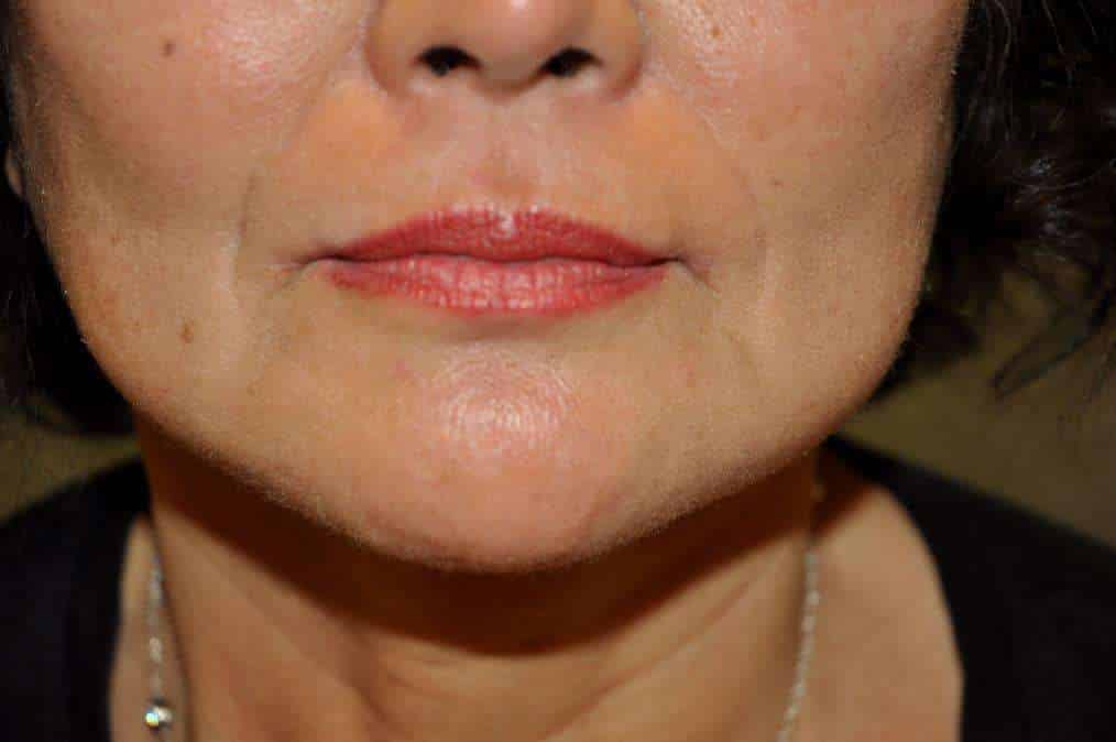 Corner Lip Lift