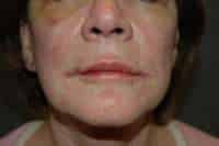 Corner Lip Lift