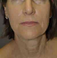 Facelift
