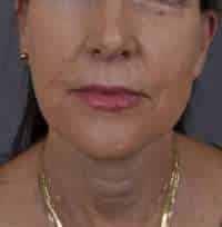 Facelift