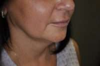 Lip Lift