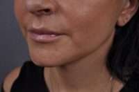 Lip Lift