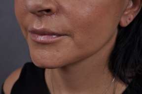 Lip Lift
