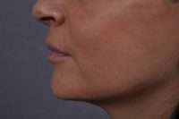Lip Lift