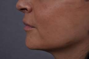 Lip Lift