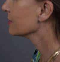 Facelift