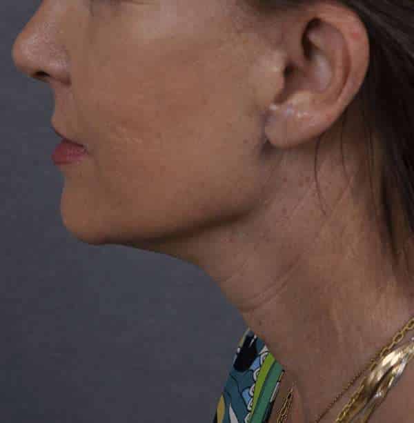 Facelift