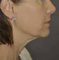 Facelift