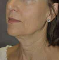 Facelift