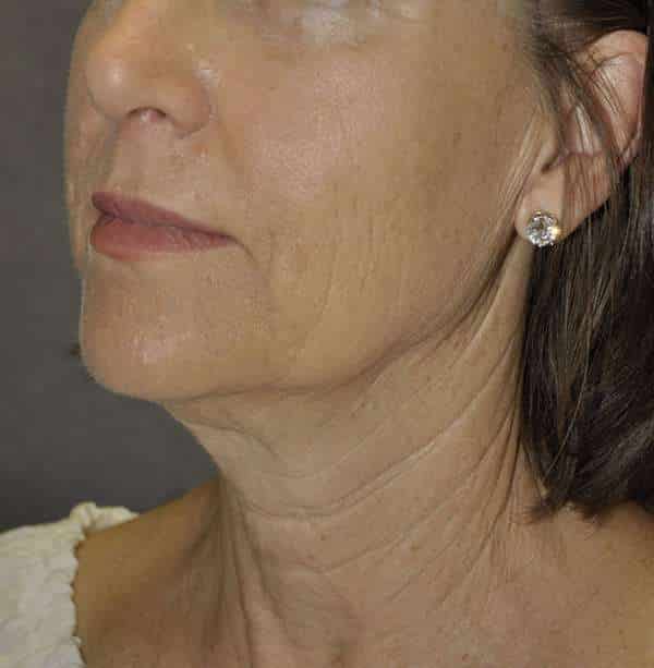 Facelift