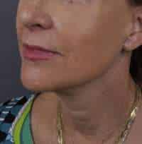 Facelift