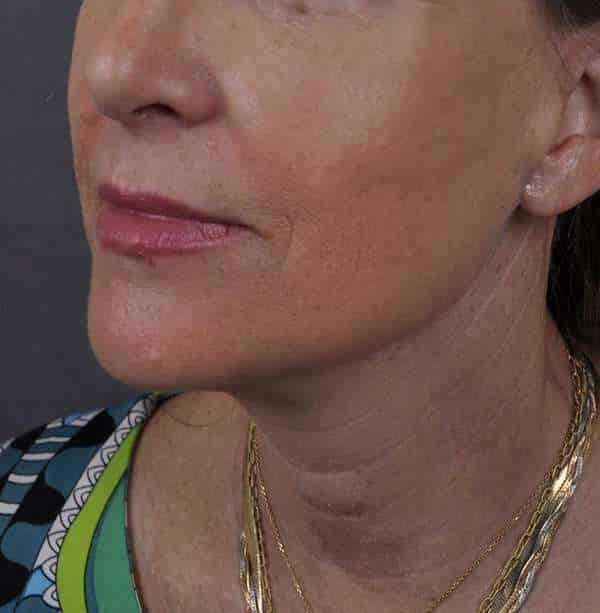 Facelift