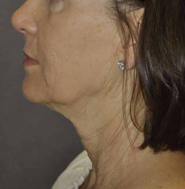 Facelift