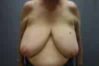 Breast Reduction