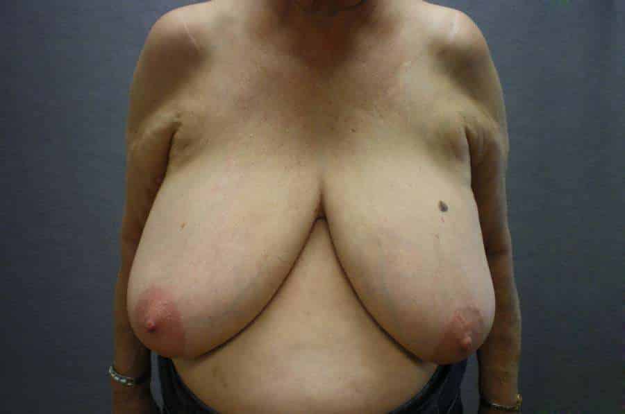 Breast Reduction