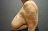 Breast Reduction