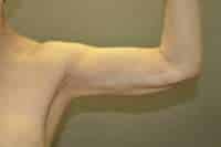 Arm Lift
