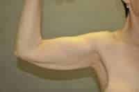 Arm Lift