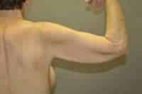 Arm Lift