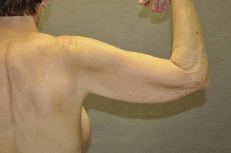 Arm Lift