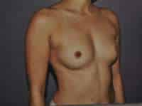 Breast Augmentation