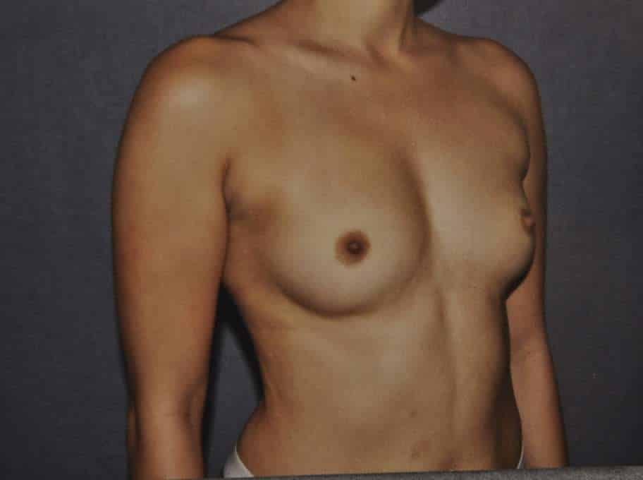 Breast Augmentation