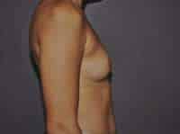 Breast Augmentation