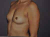 Breast Augmentation