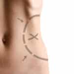 lipectomy procedure for body sculpting
