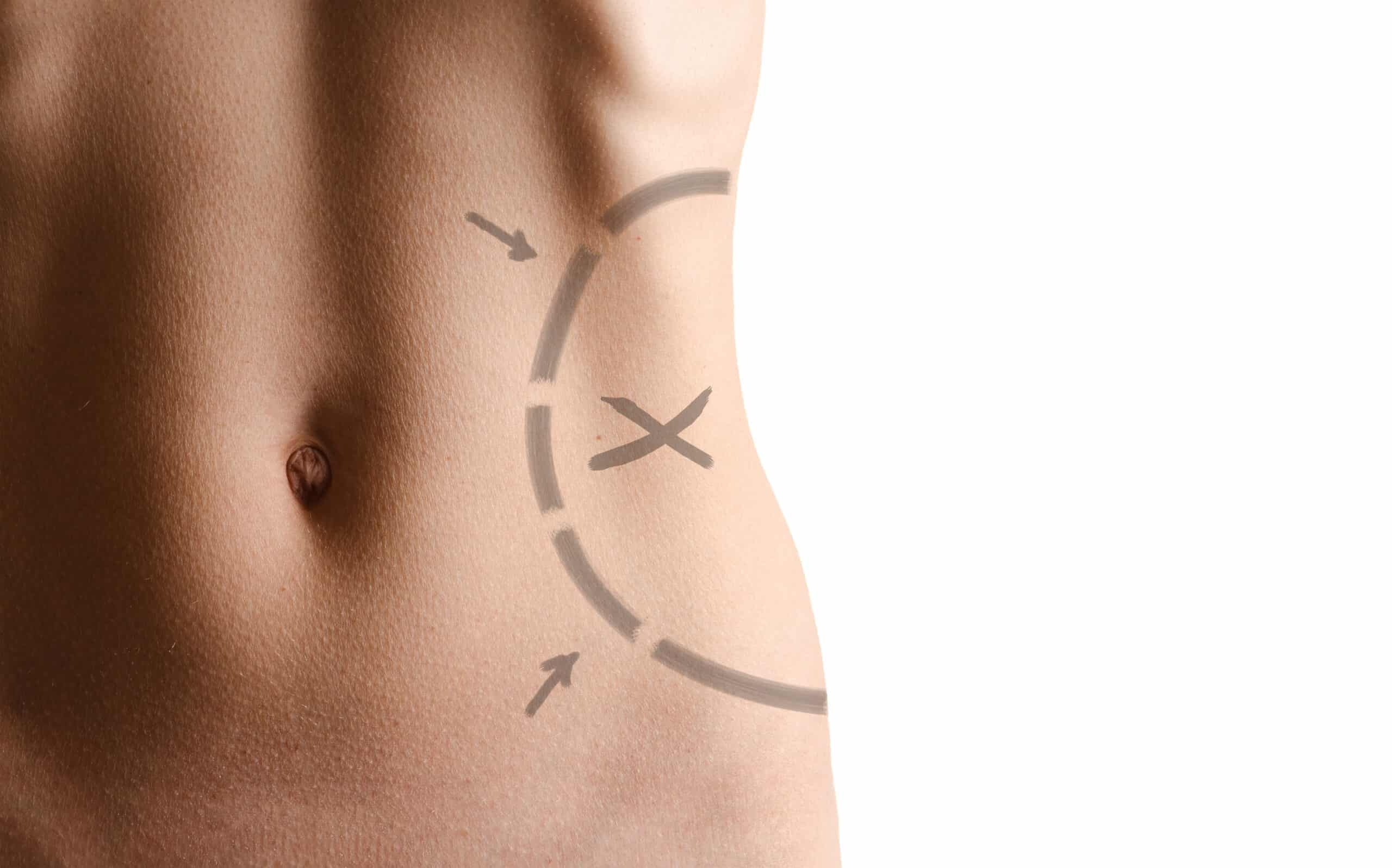 lipectomy procedure for body sculpting