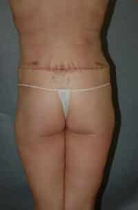 Belt Lipectomy