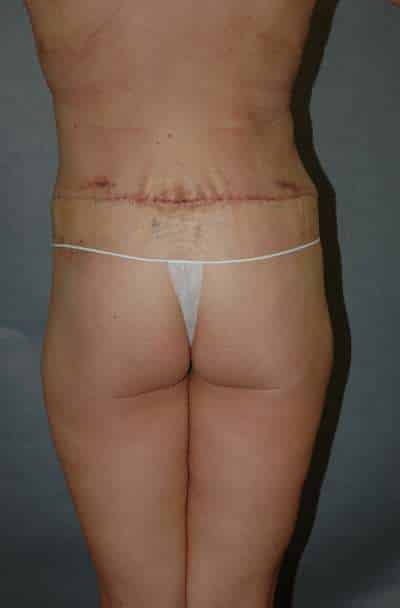 Belt Lipectomy