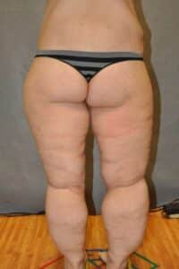 Thigh Lift