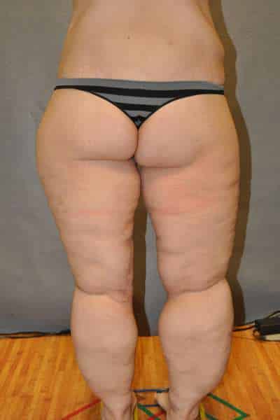 Thigh Lift