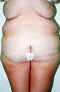 Belt Lipectomy