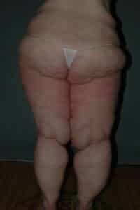 Thigh Lift